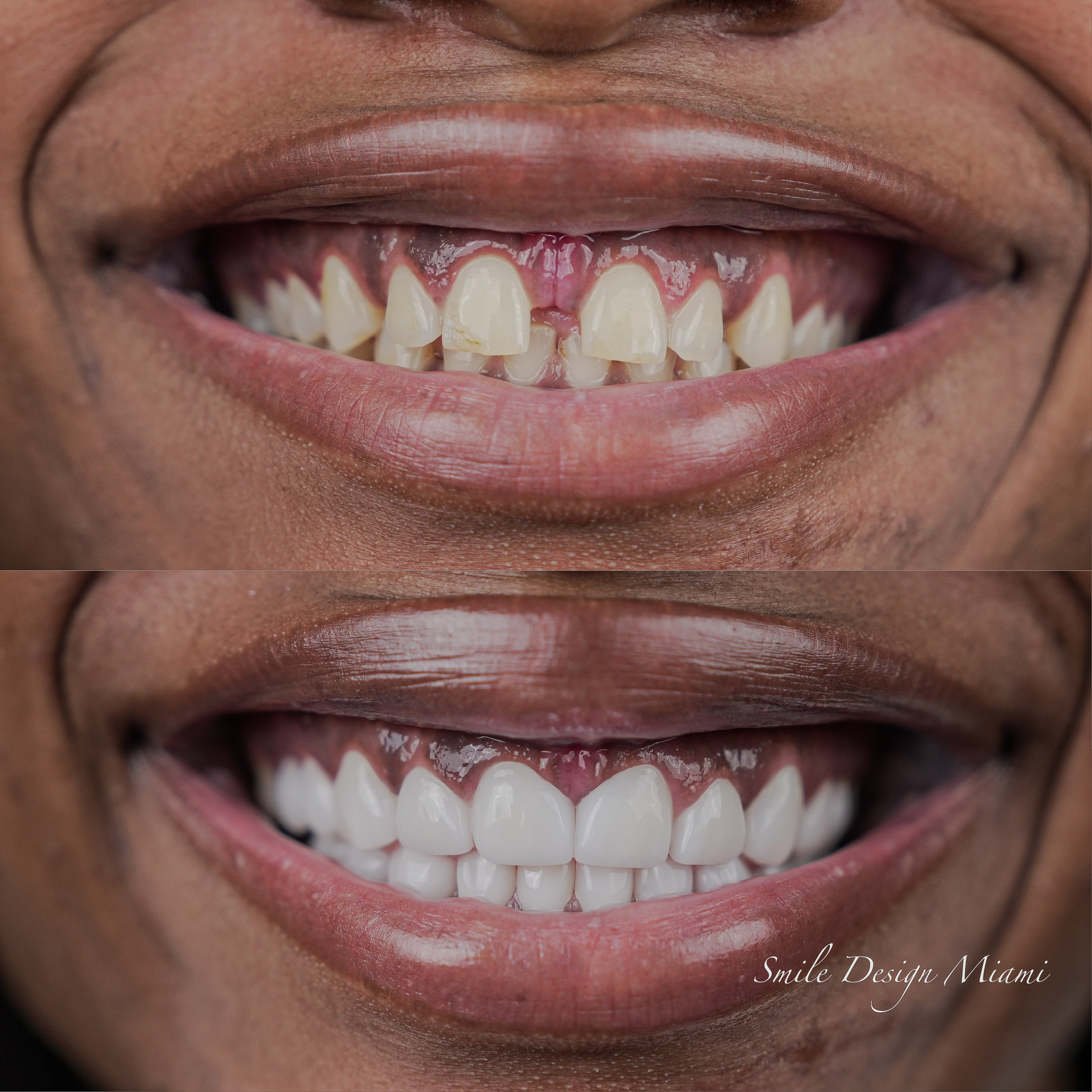 Smile Makeover