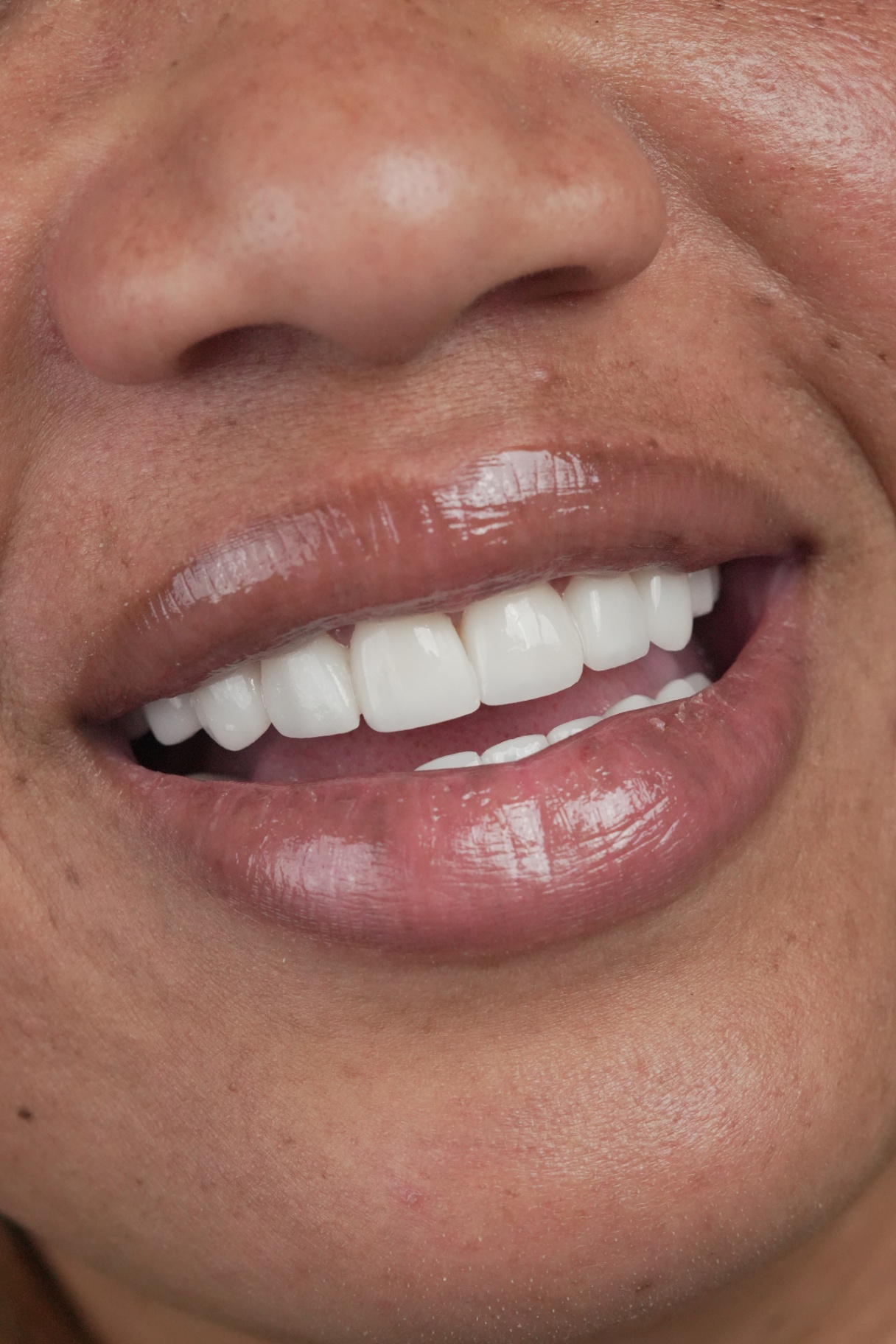 Smile transformation 5