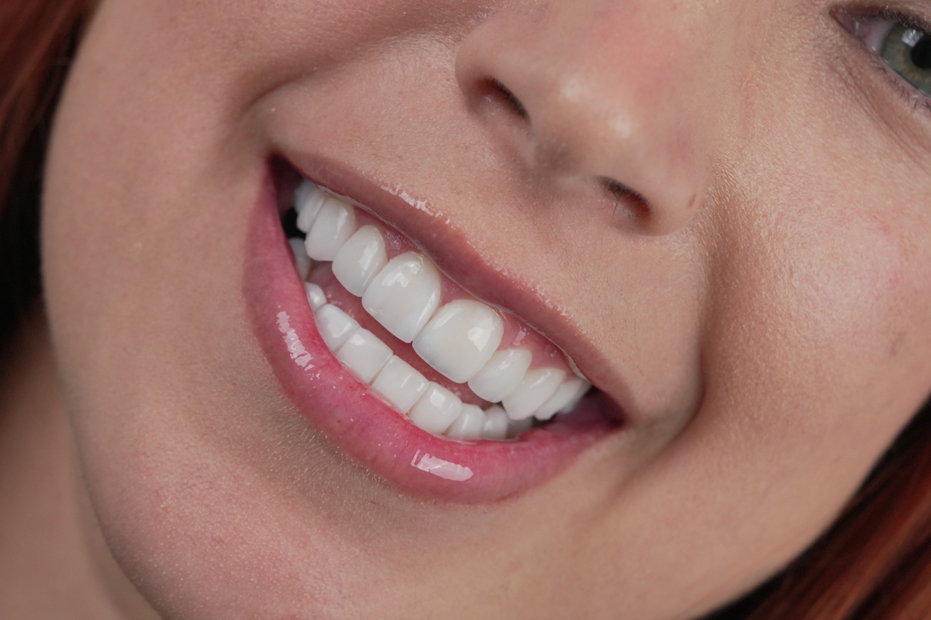 Smile transformation 8
