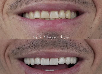 Porcelain Veneers & Smile Makeovers