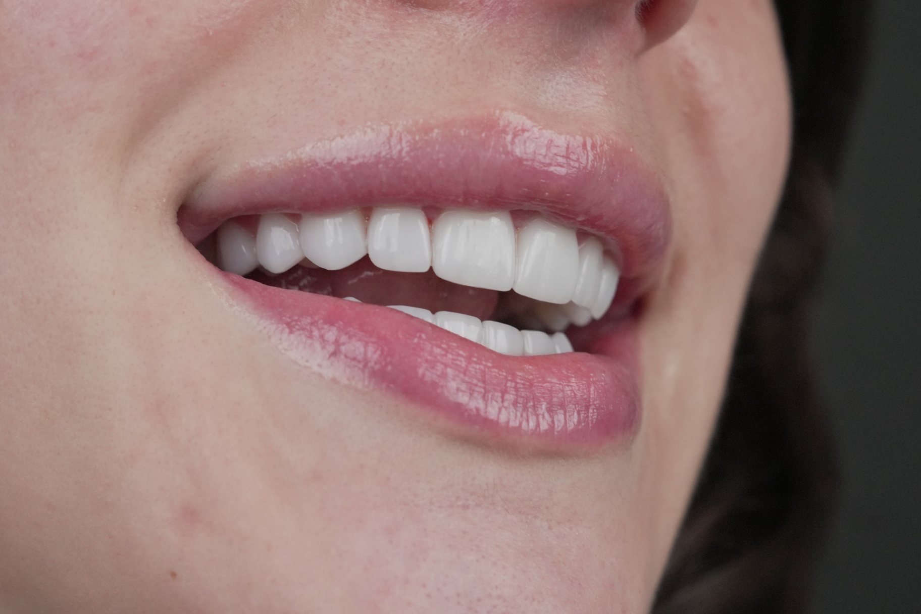 Smile transformation 2