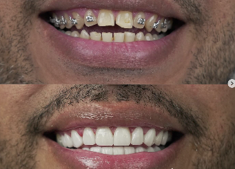 Orthodontics & Smile Alignment