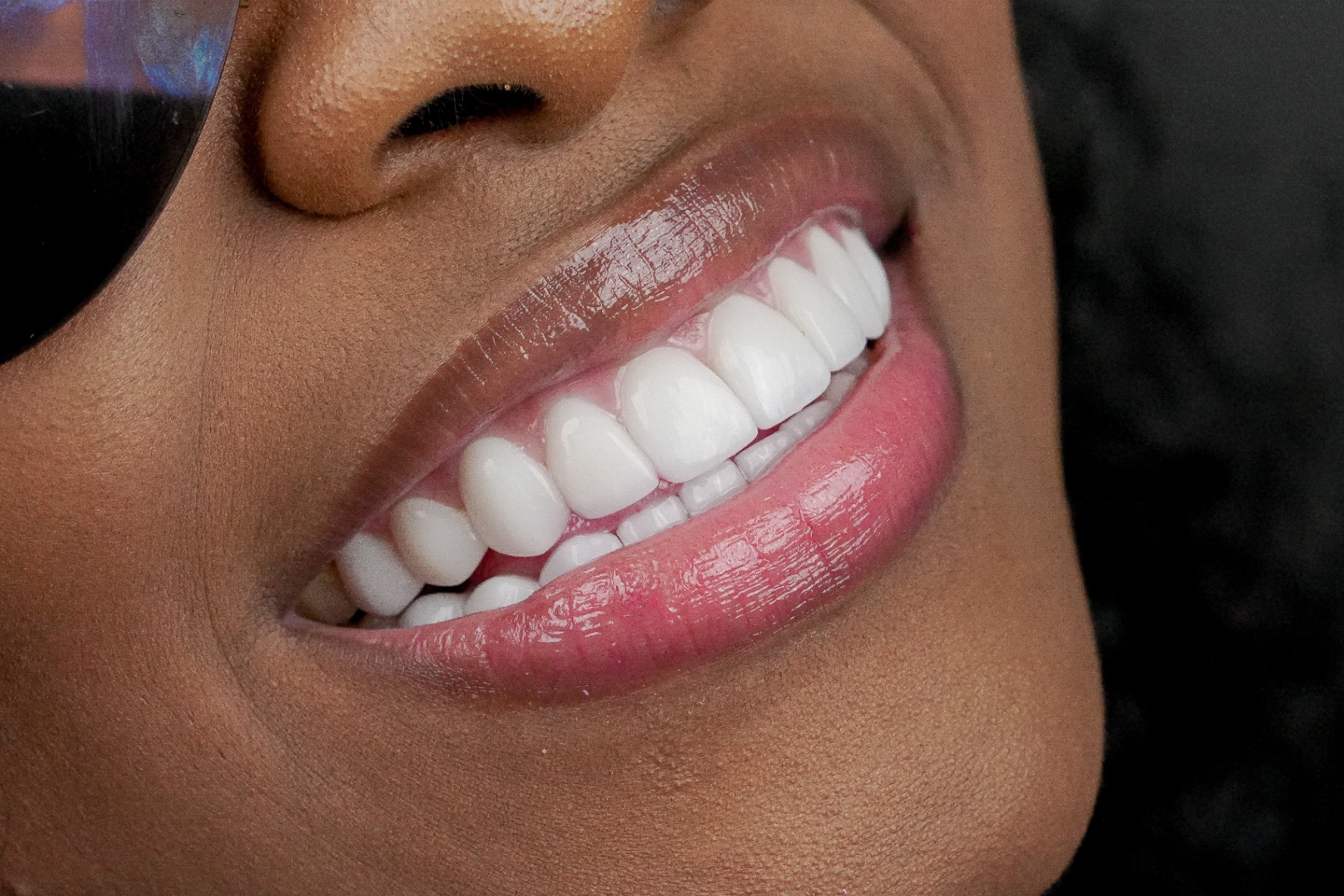 Smile transformation 7