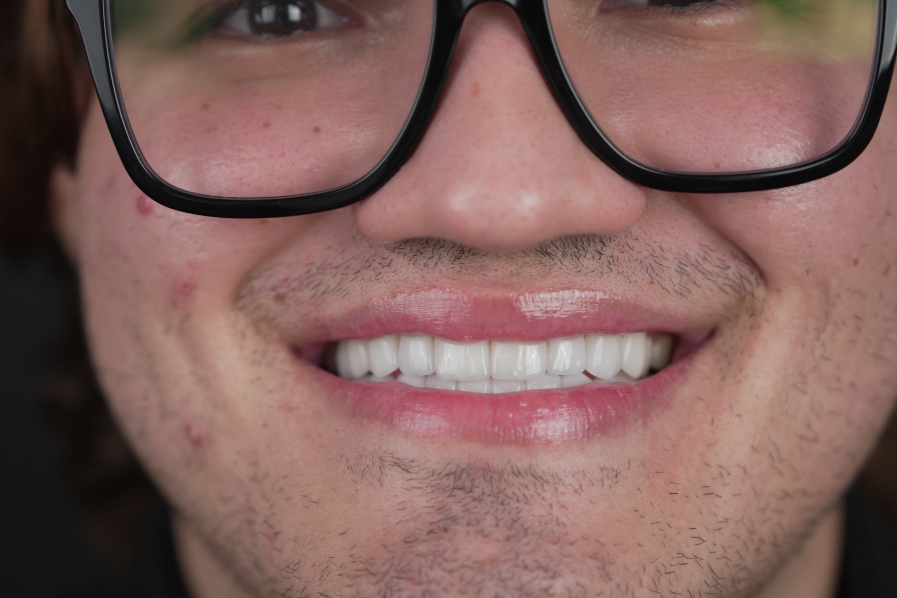 Smile transformation 4