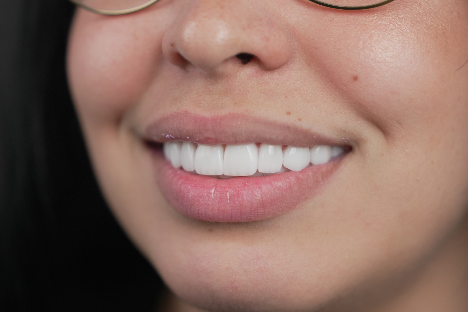 Smile transformation 3