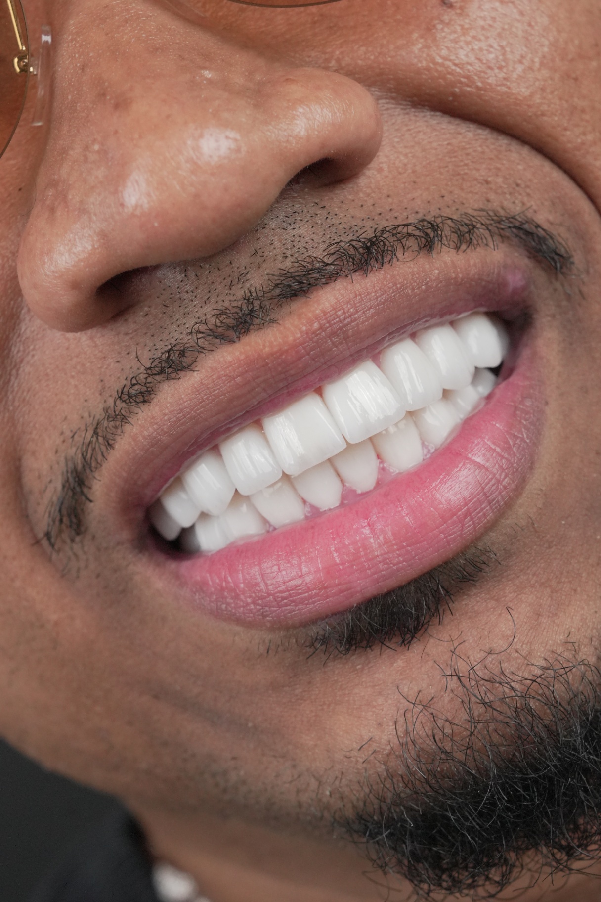Smile transformation 6