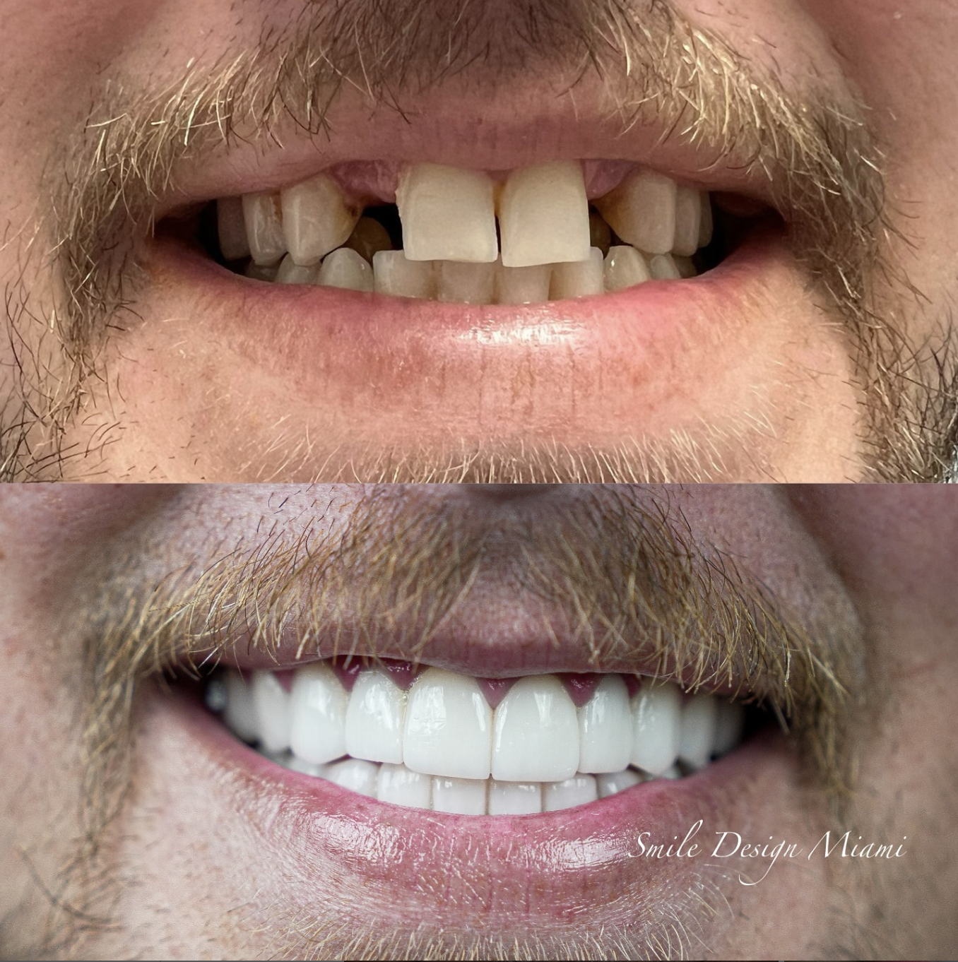 ALL ON X Dental Implants