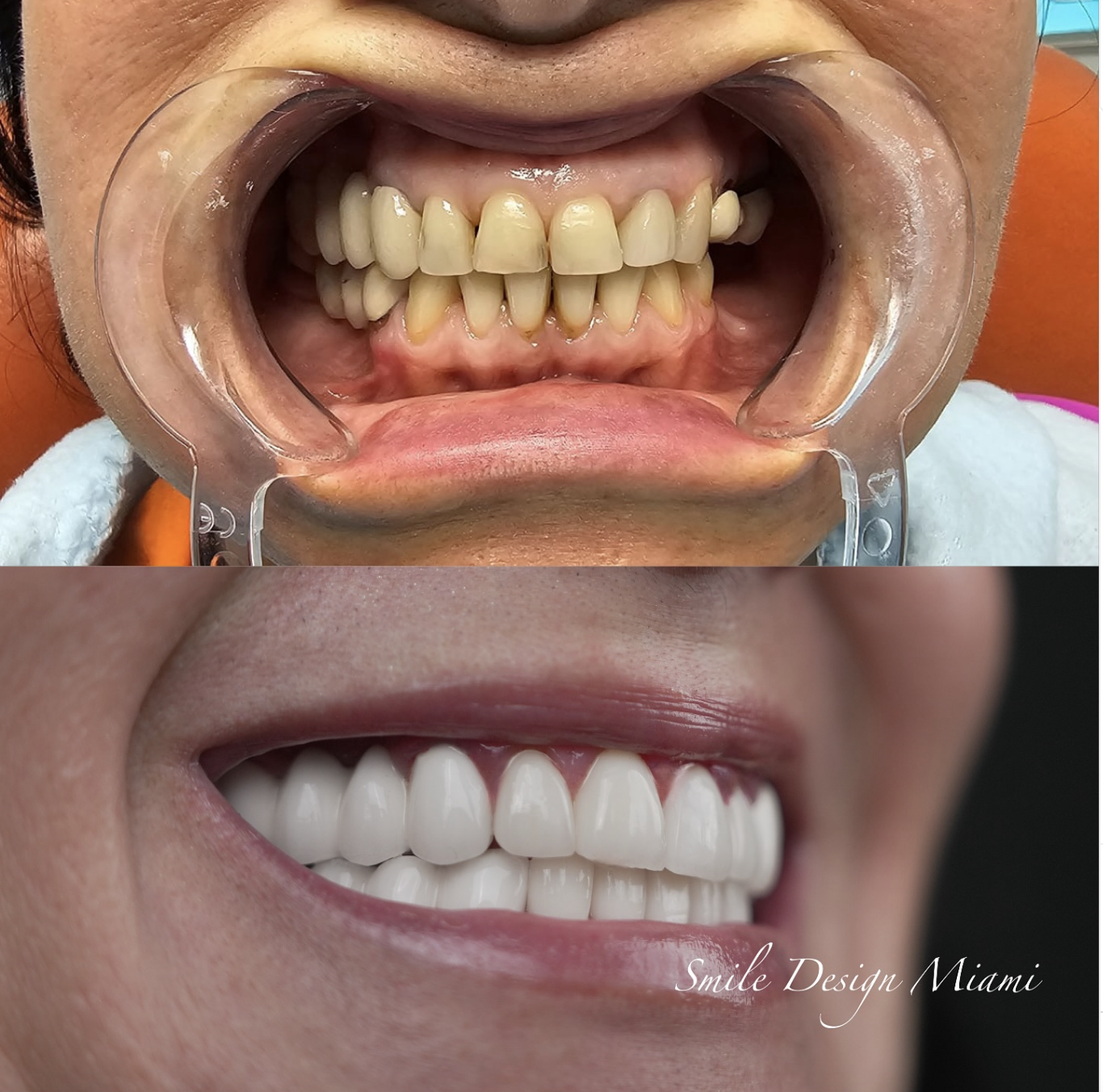 Dental Veneer Procedure