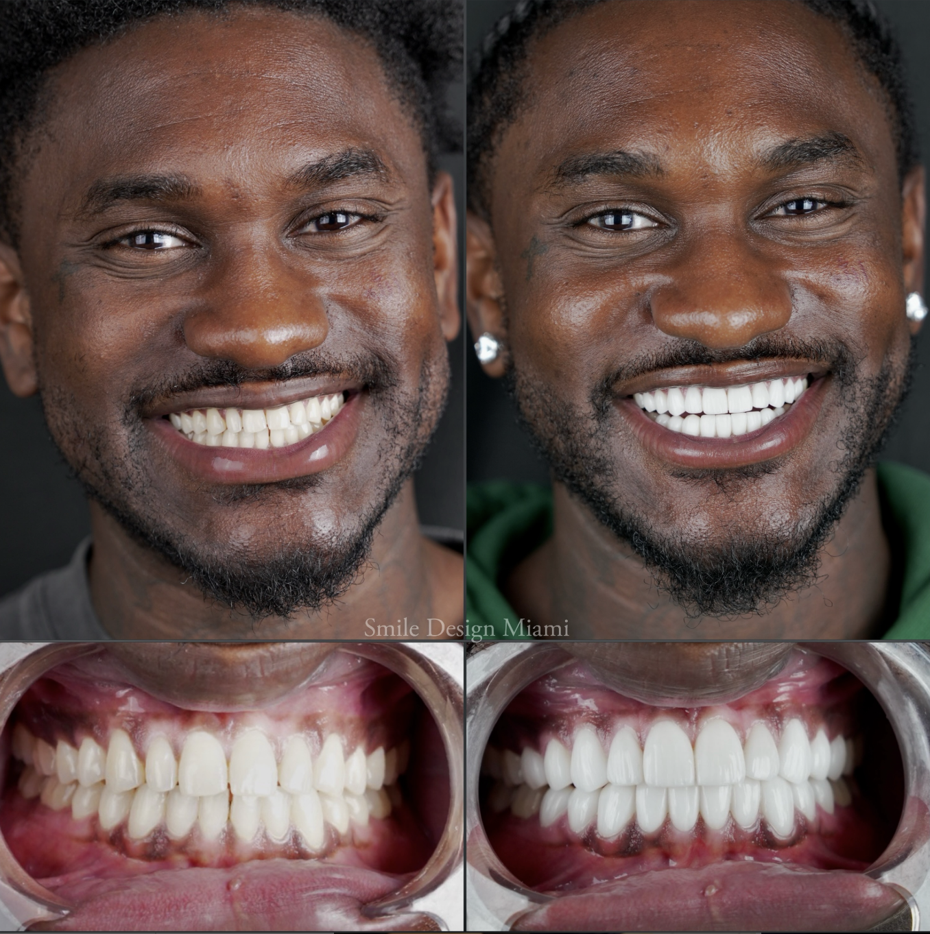 Professional Dental Cleaning