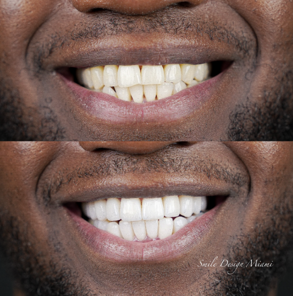 Veneers vs Crowns