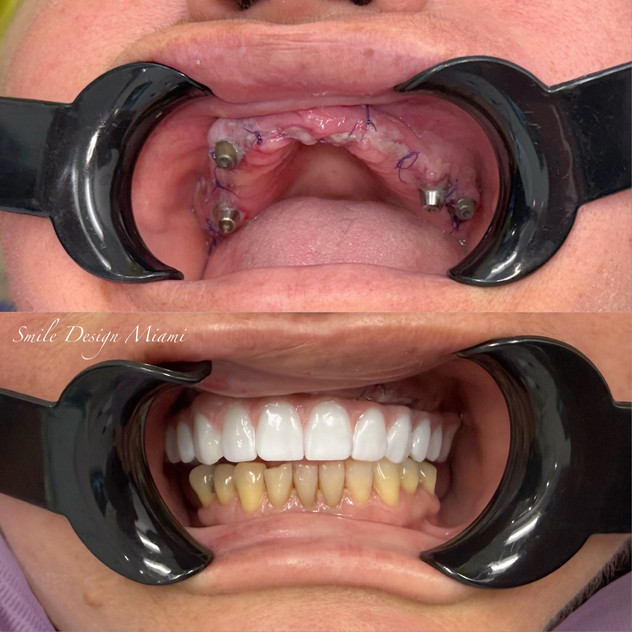 Dental Implants & Full Arch Restoration