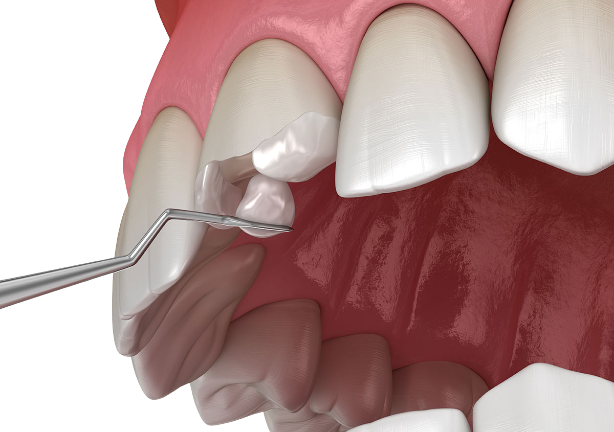 Cosmetic Bonding & Restorative Dentistry