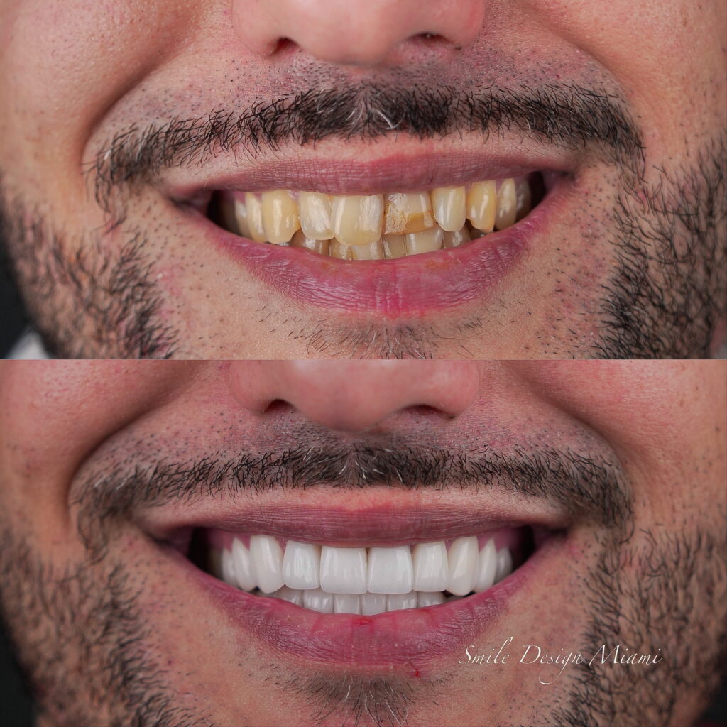Before and after teeth whitening