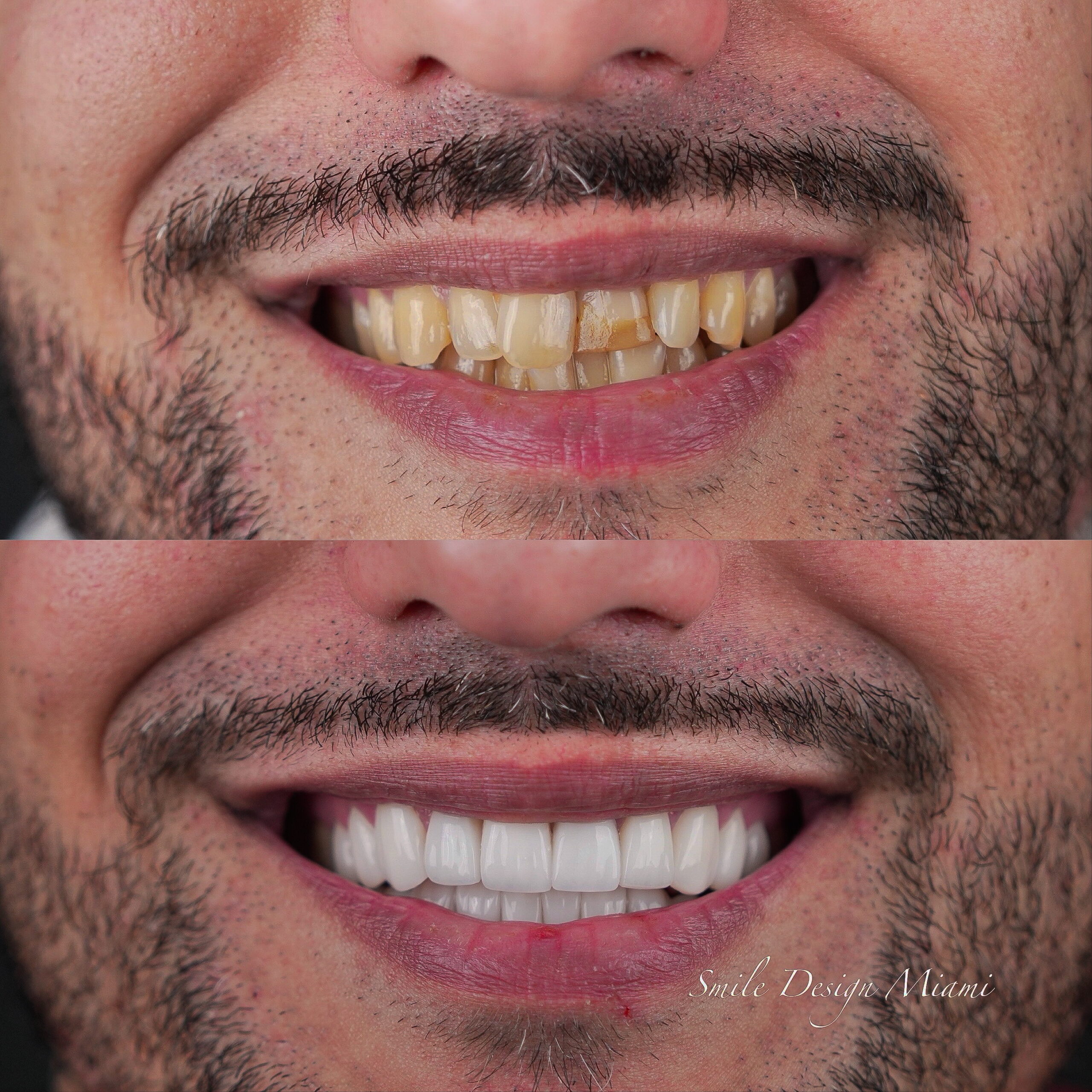 Before and after teeth whitening