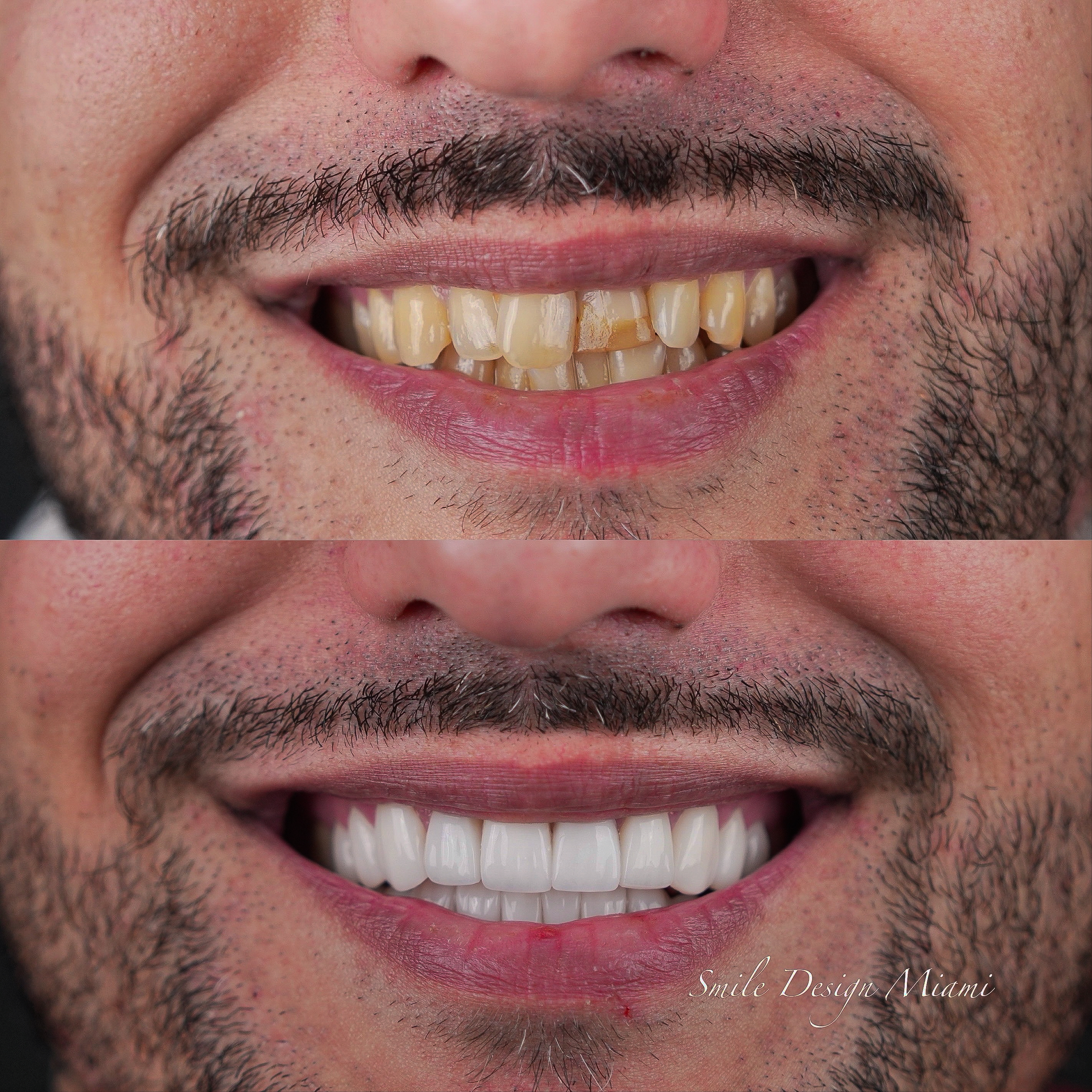 Veneer Transformation - Case 2