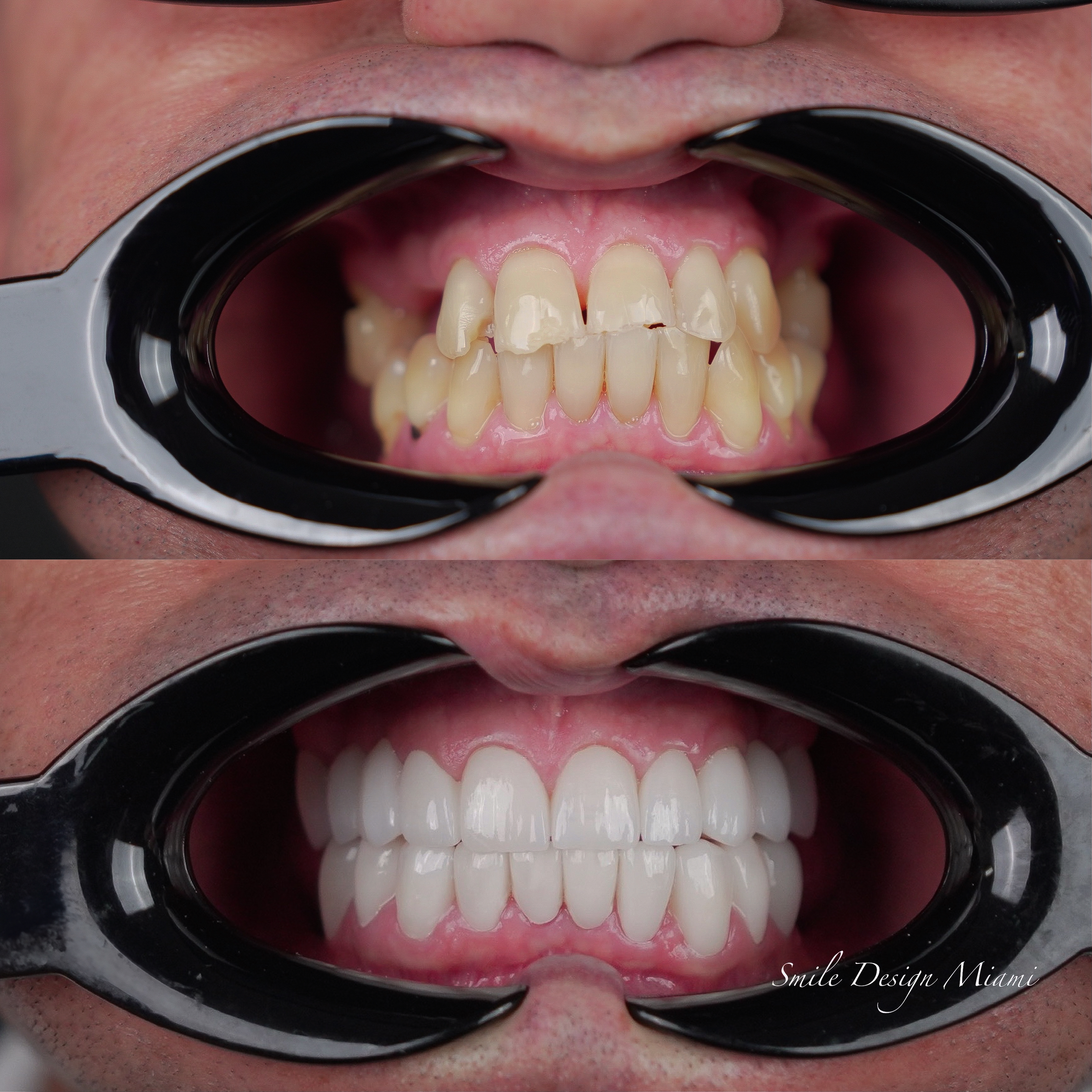 Veneer Transformation - Case 3