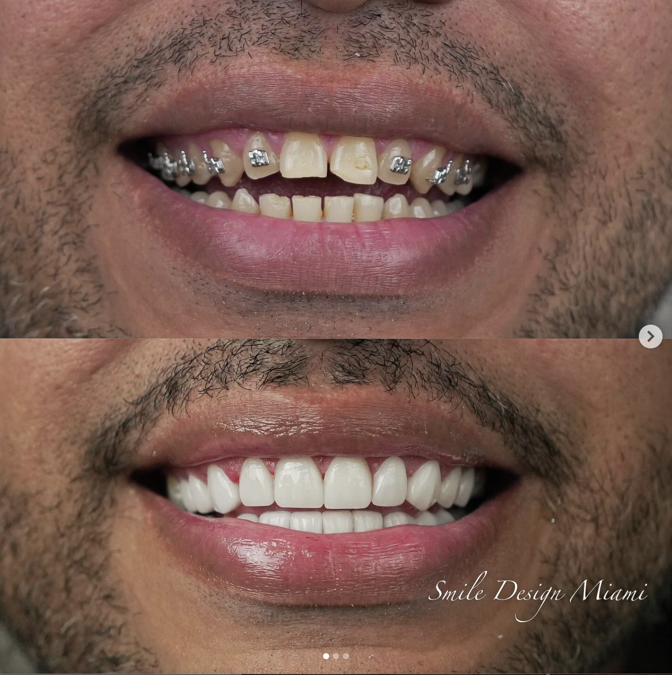 Are You a Good Candidate for Veneers?