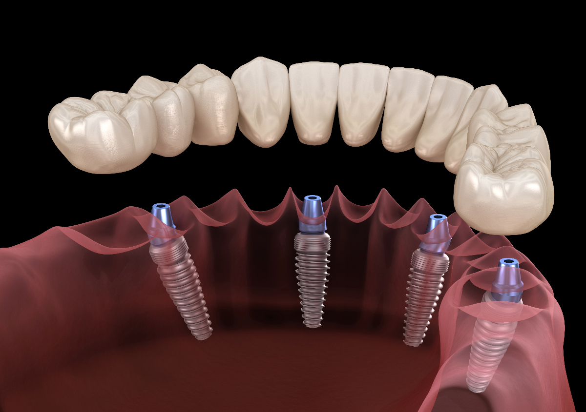ALL ON X Dental Implants