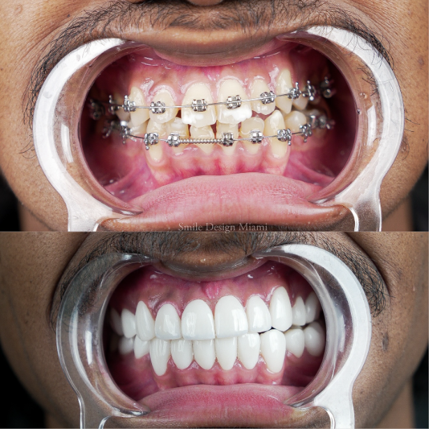 Orthodontic Treatment