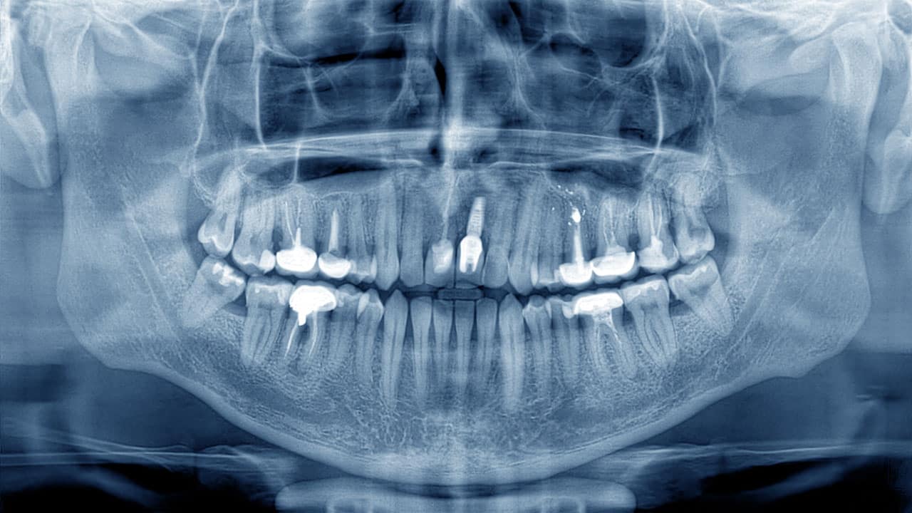 Dental Radiographs