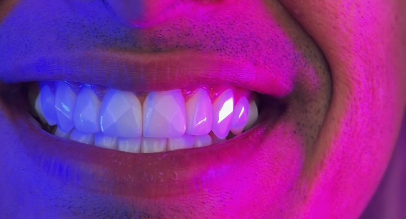 Close-up of a bright white smile with pink and blue lighting, showing cosmetic dentistry results in Miami.