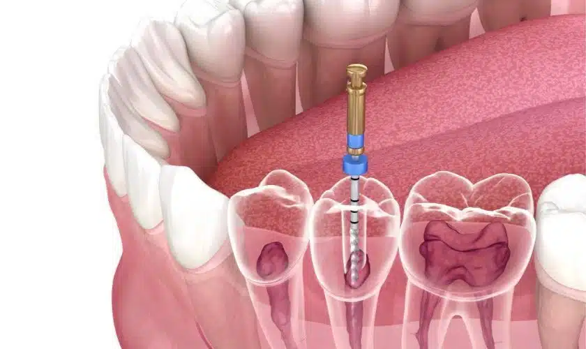 Miami cosmetic dentist performing root canal on lower molar, dental file inserted, with gum and teeth visible in illustration.