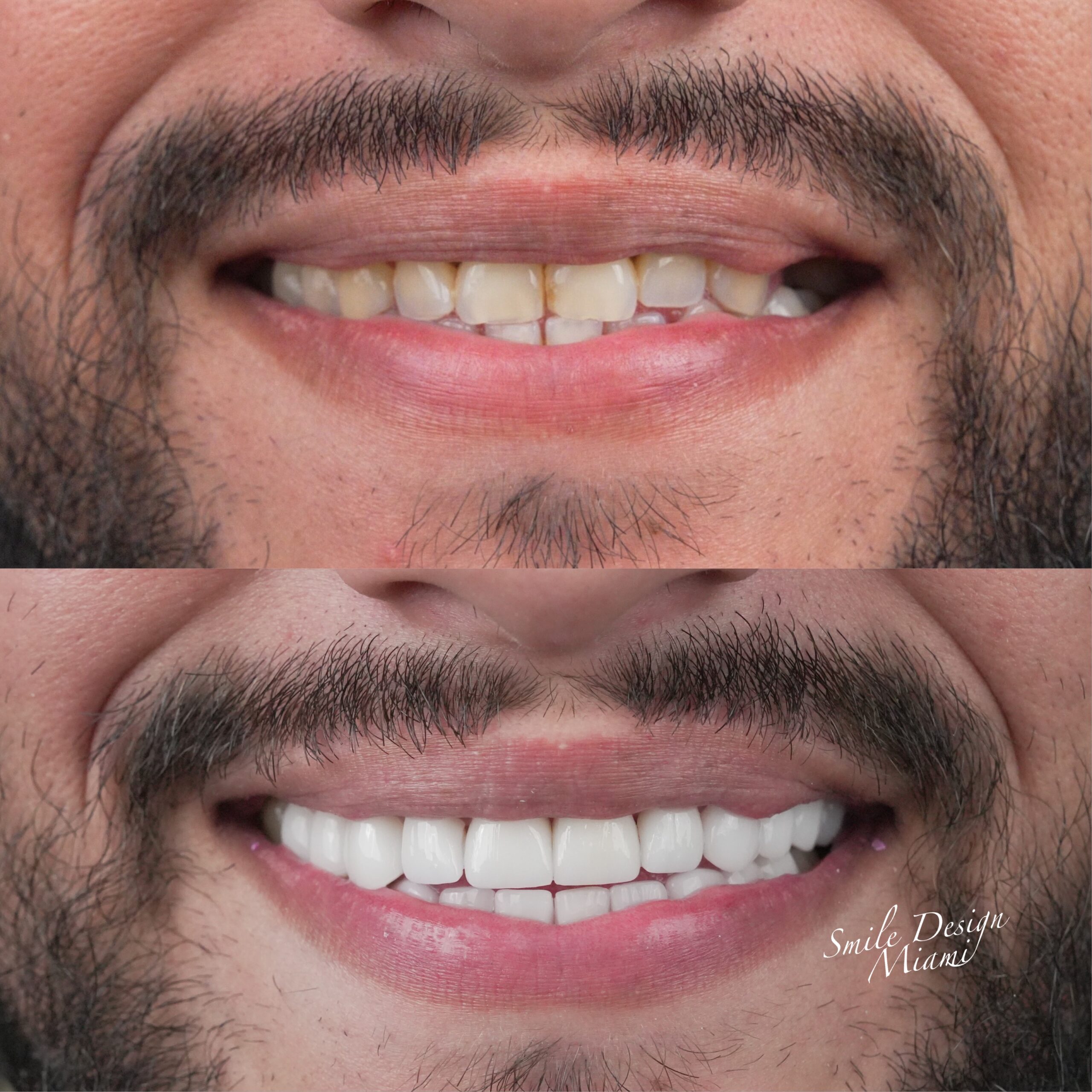 Before and after teeth whitening comparison