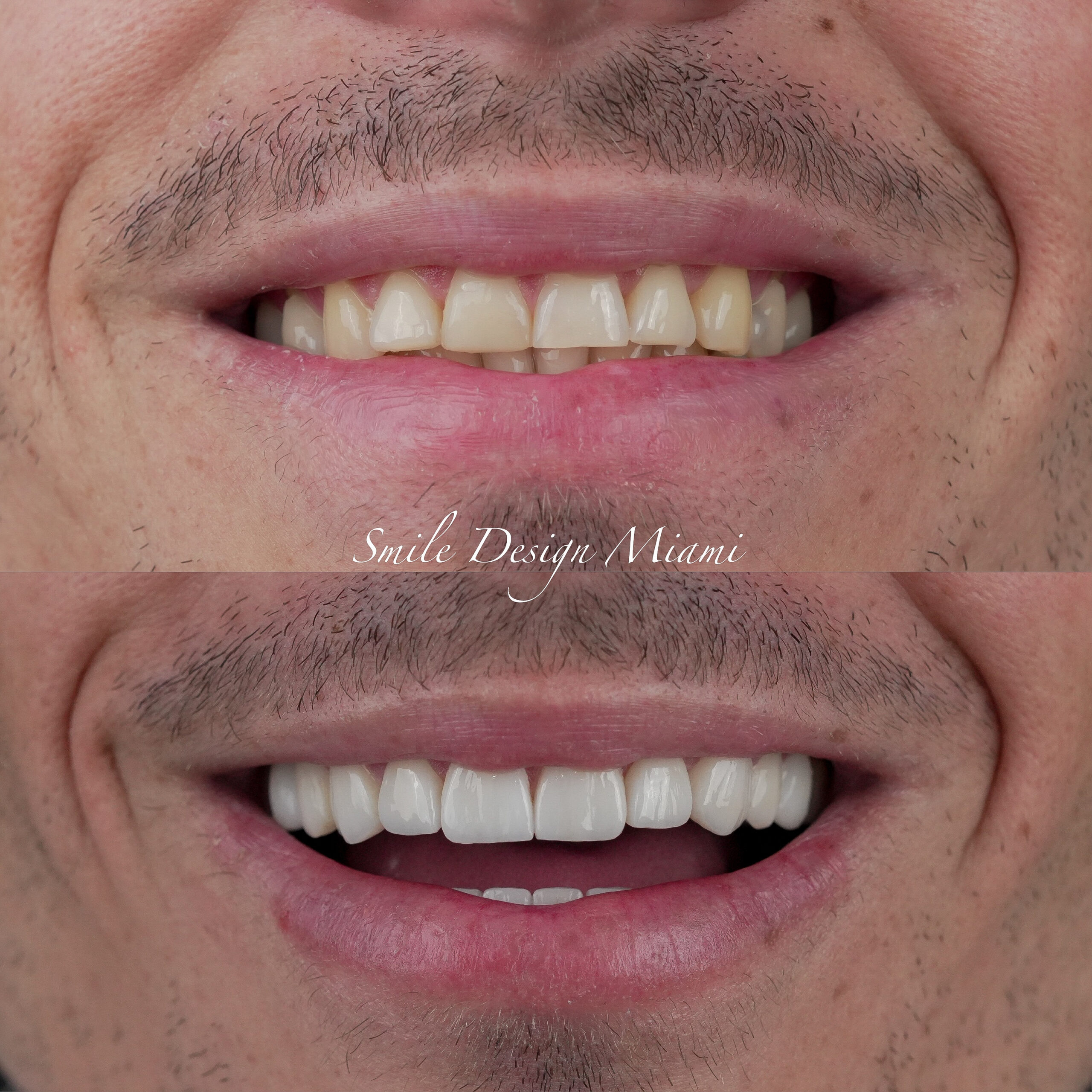 Before and after smile makeover showing whiter, straighter teeth in Miami