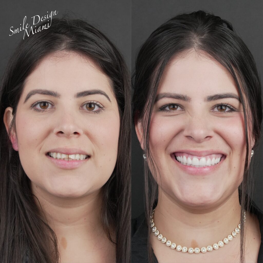 Smile Design Miami patient before and after smile makeover results